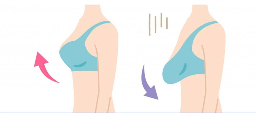 Sagging Breasts