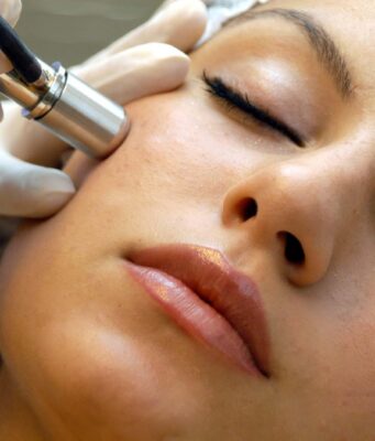 microdermabrasion 3