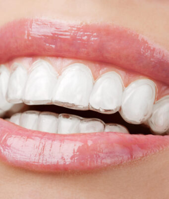 What is Invisalign scaled