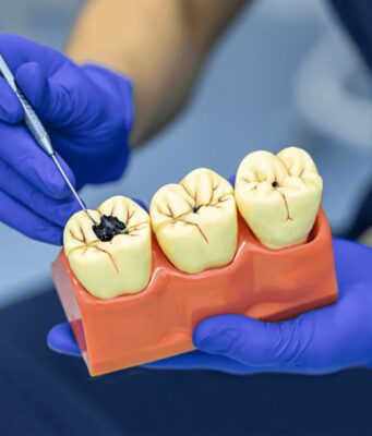 Causes of Tooth Decay