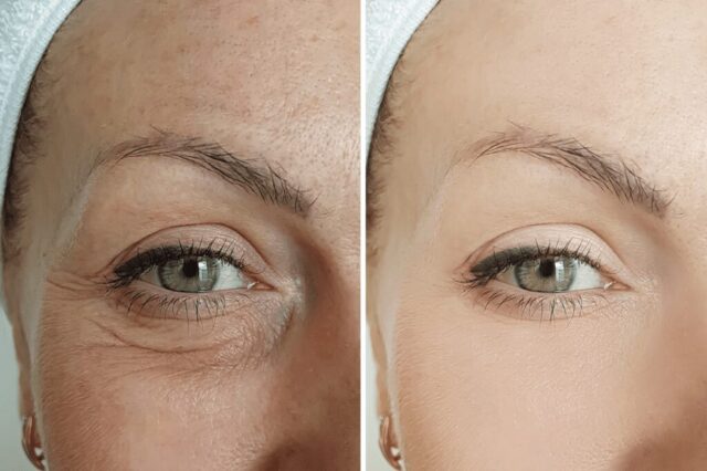 Microneedling and Wrinkles