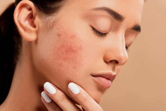 Milk of Magnesia for acne