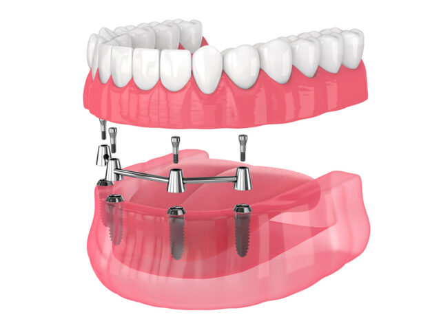 Life Changing Benefits of All On 4 Dental Implants Life Changing Benefits of All On 4 Dental Implants