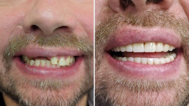 Transformations from All On 4 Implants Transformations from All On 4 Implants